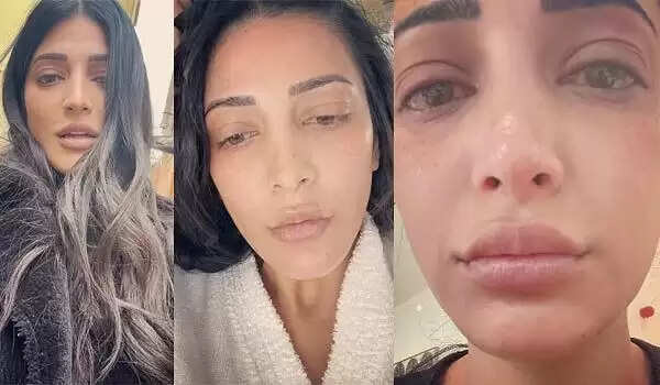 எப்படி இருந்த நான் இப்படி ஆயிட்டேன்.. கண்ணு கலங்கி, முகம் வீங்கிய ஸ்ருதிஹாசனின் அதிர்ச்சி புகைப்படம்