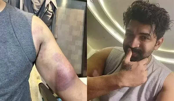 சண்டைக் காட்சிகள் அருண் விஜய்க்கு ஏற்பட்ட பலத்த காயம்.. ரசிகர்களை கலங்க வைத்த வைரல் புகைப்படம்